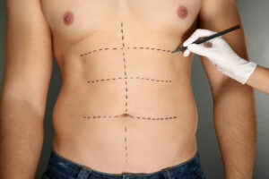 abdominoplasty