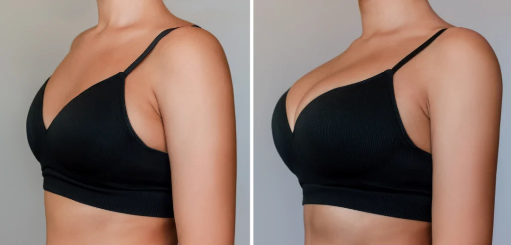 Before and after comparison of a patient showcasing results of a breast lift.